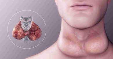 what symptoms of hypothyroidism