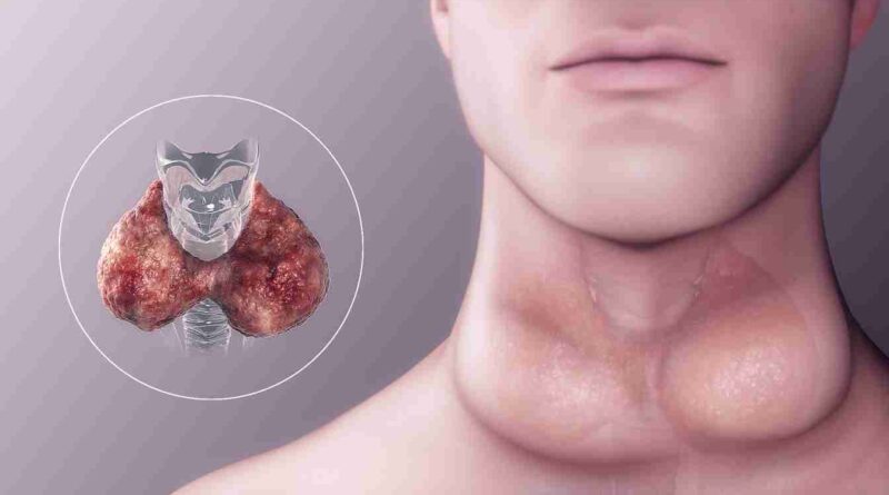 what symptoms of hypothyroidism