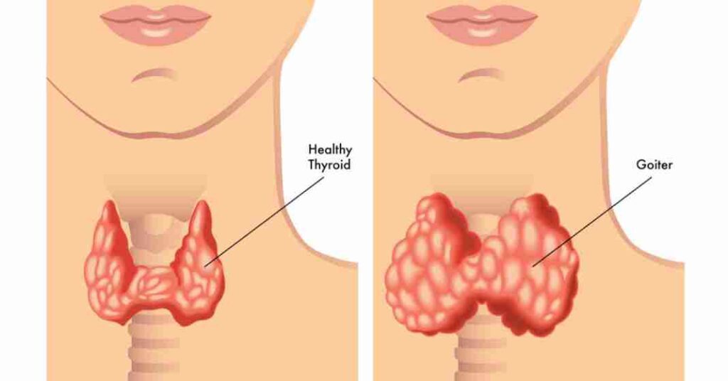 hypothyroidism problems and remedies